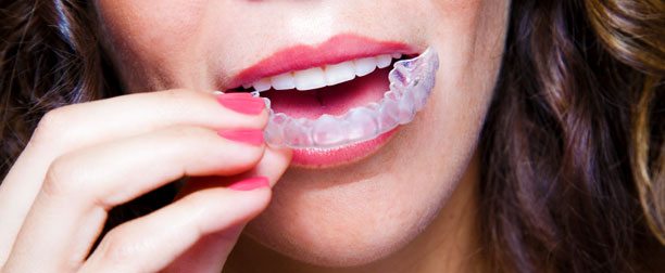 invisalign clear braces dentist los angeles