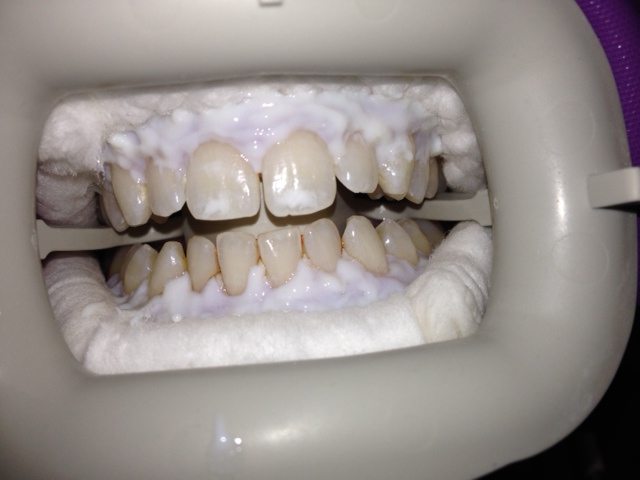 Zoom Whitening Los Angeles before