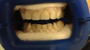 zoom whitening los angeles