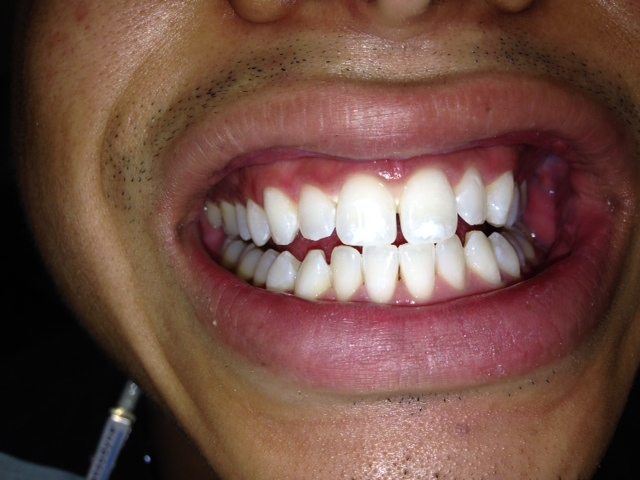 Great Result for Zoom Whitening in Los Angeles