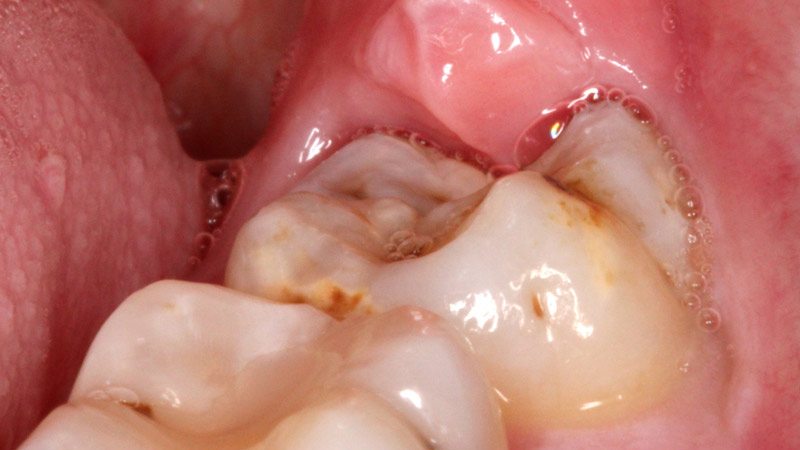 wisdom teeth pain pericornitis