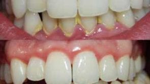 Gum Disease: Gingivitis Treatment in Los Angeles