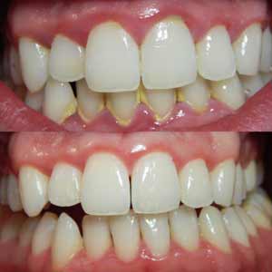 Gum Disease: Gingivitis Treatment in Los Angeles