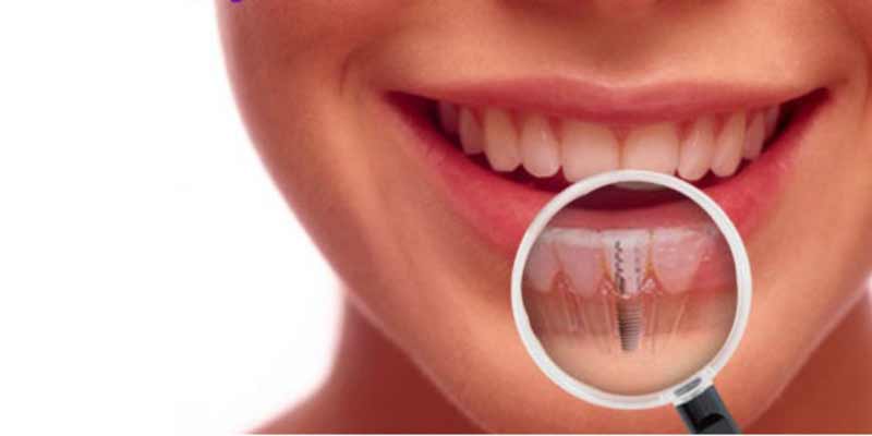 natural look dental implants in los angeles