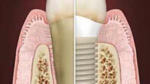 Dental Implants in Los Angeles