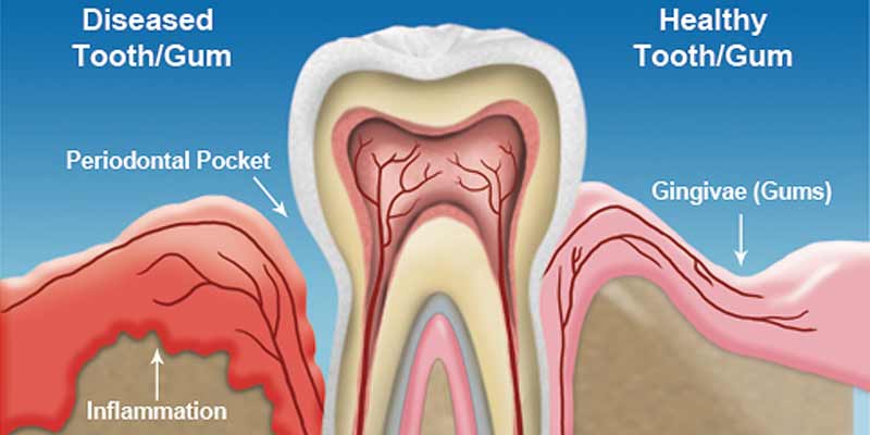 periodontitis treatment in los angeles