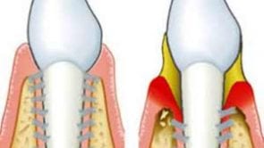 Gum Disease: Periodontitis Treatment in Los Angeles