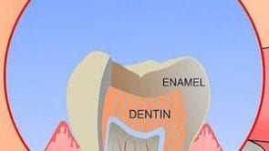 tooth-enamel-erosion-treatment-los-angeles-small