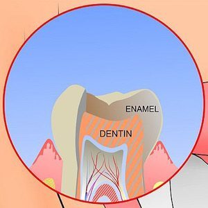 tooth-enamel-erosion-treatment-los-angeles-small