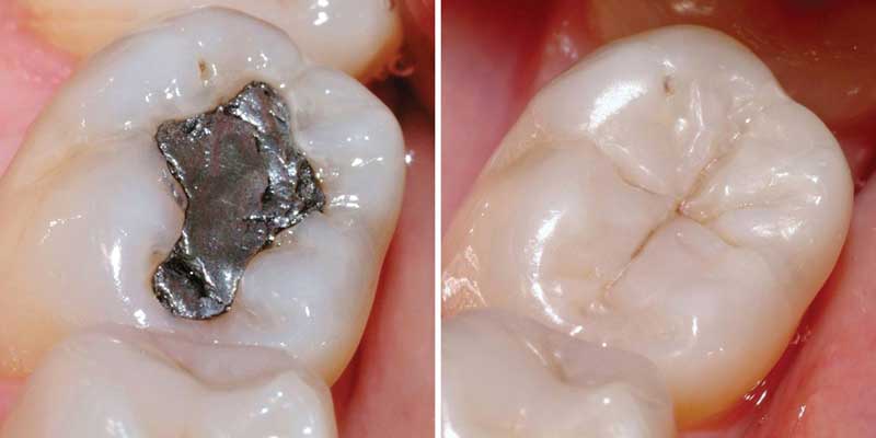 amalgam fillings metal-free filling la dentist recommends