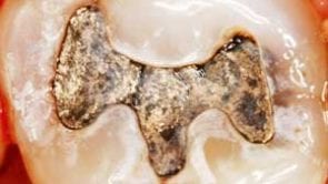 fillings dtla los angeles dentist