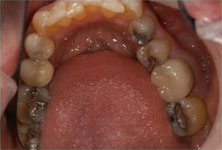 dental-crowns-before-sm