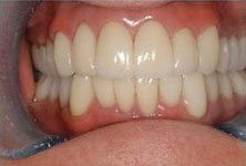 teeth-whitening-after-sm
