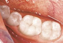 white-fillings-after-sm