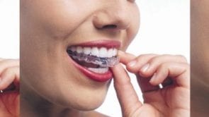 Putting on Invisalign Braces